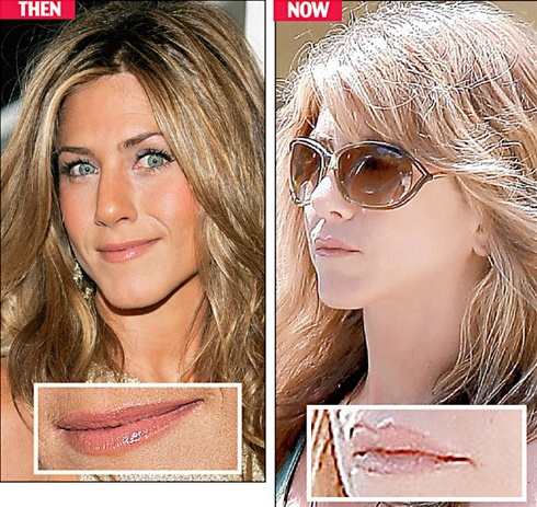 Chirurgie de star: Jennifer Aniston