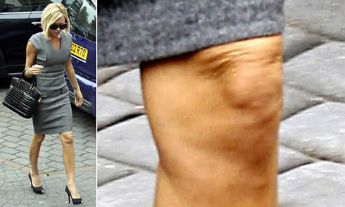 Stars avec cellulite: Victoria Beckham et cellulite