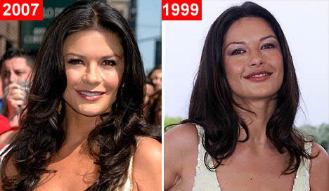 Chirurgie esthétique de star: Catherine Zeta-Jones