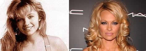 Chirurgie de star: Pamela Anderson et la chirurgie esthétique